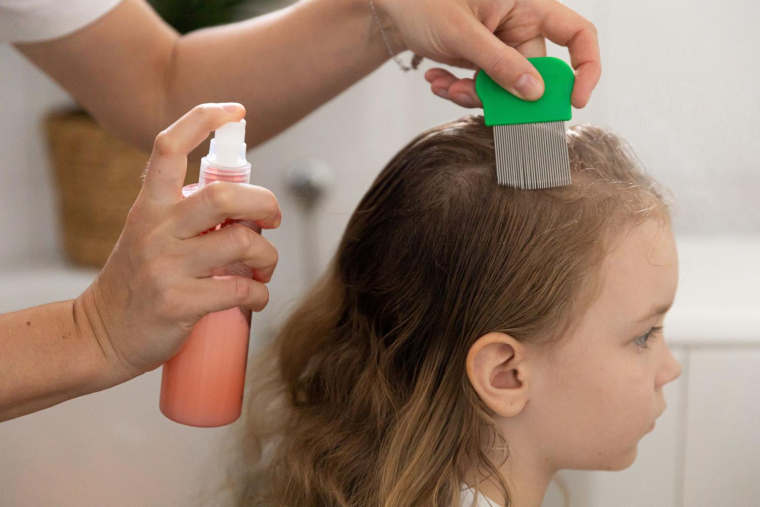 Il existe des alternatives aux shampoings toxiques pour se débarrasser des poux. ( crédit photo : Shutterstock )