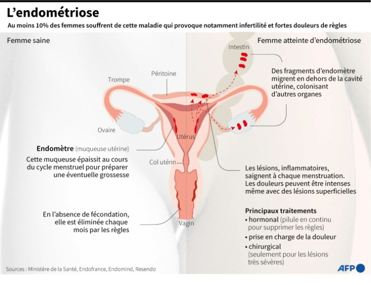 Graphique expliquant le fonctionnement de l'endométriose, ses principaux symptômes et traitements ( AFP / Paz PIZARRO )
